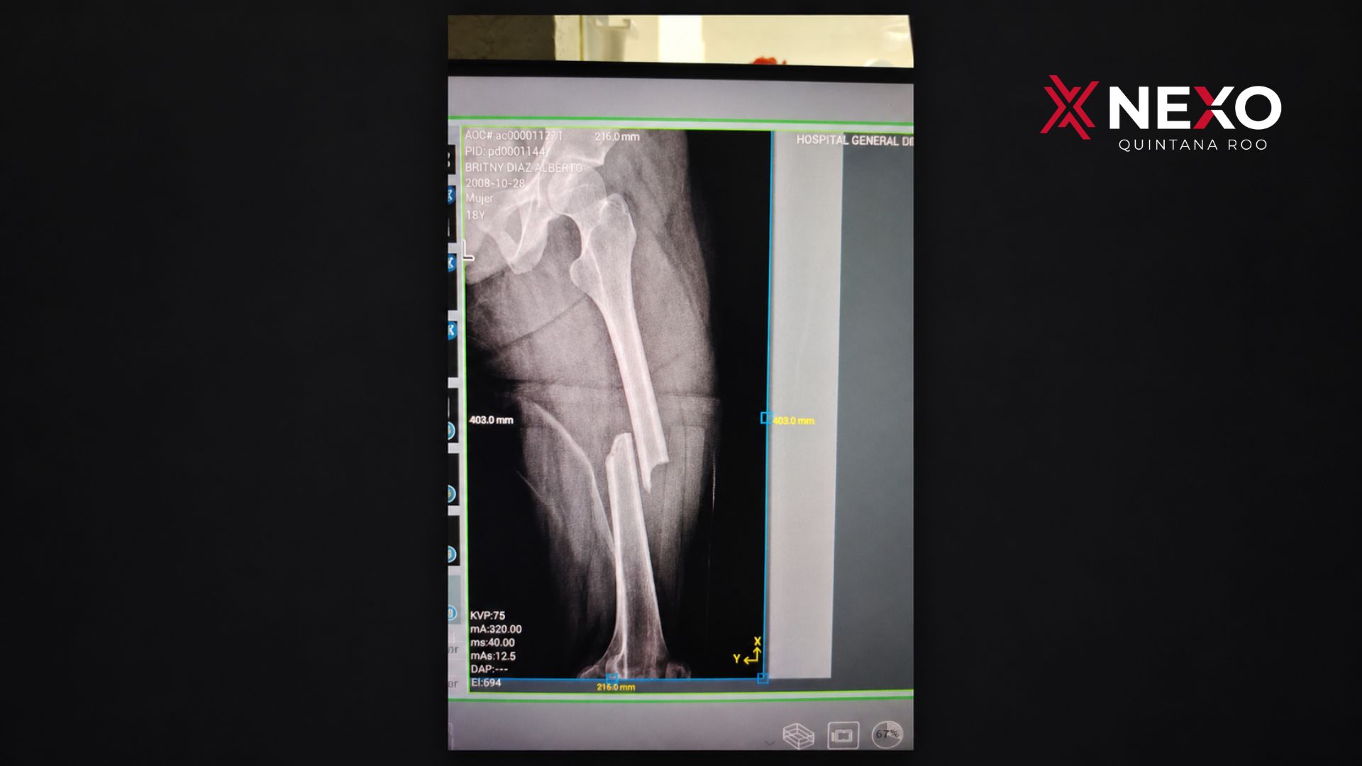 Radiografía que muestra una fractura de fémur, relacionada con el accidente de motocicleta ocurrido en Felipe Carrillo Puerto.